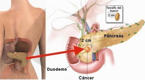 cancer-de-pancreas
